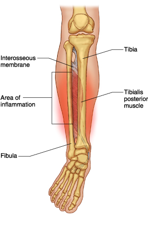 Shin Splints - Fleet Feet Stuart