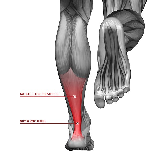 Achilles Tendinitis