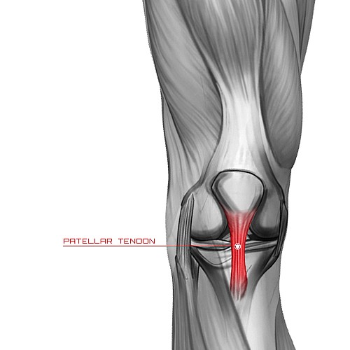 patellar tendonitis