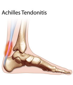 Achilles Tendonitis