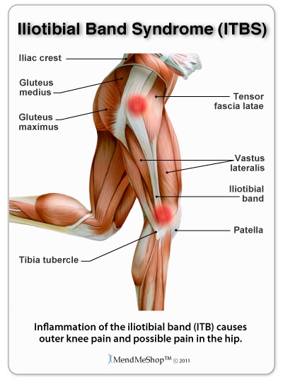 Iliotibial Band Syndrome West Des Moines IA