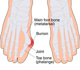 bunion