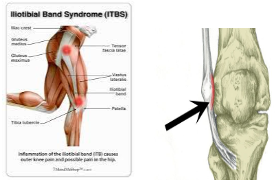 Knee Pain Could Indicate IT Band Syndrome