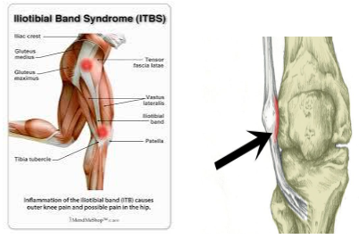 Iliotibial Band Friction Syndrome (ITBFS) - Sports Medicine Information