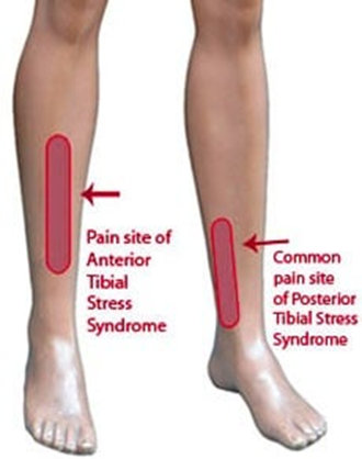 Shin splint leg pain knee injury Sport Lower tibia strain tendon muscle  fall impact trauma bone