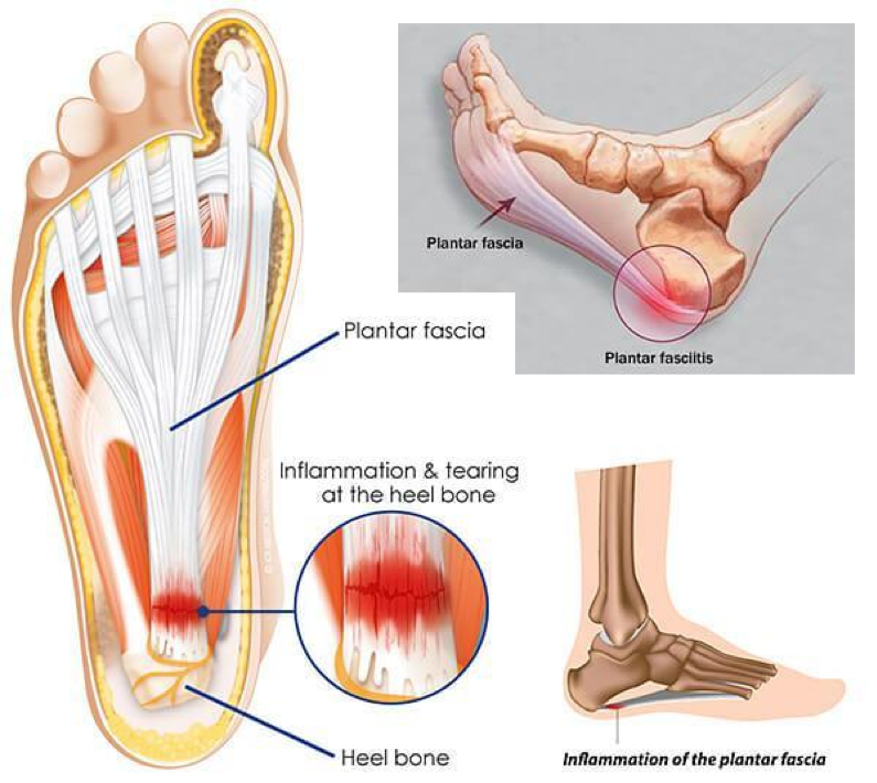 signs of planters fasciitis