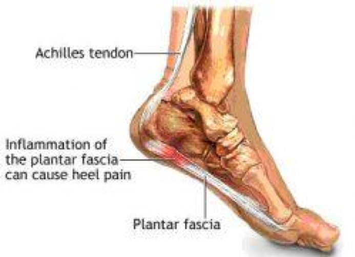 fleet feet plantar fasciitis