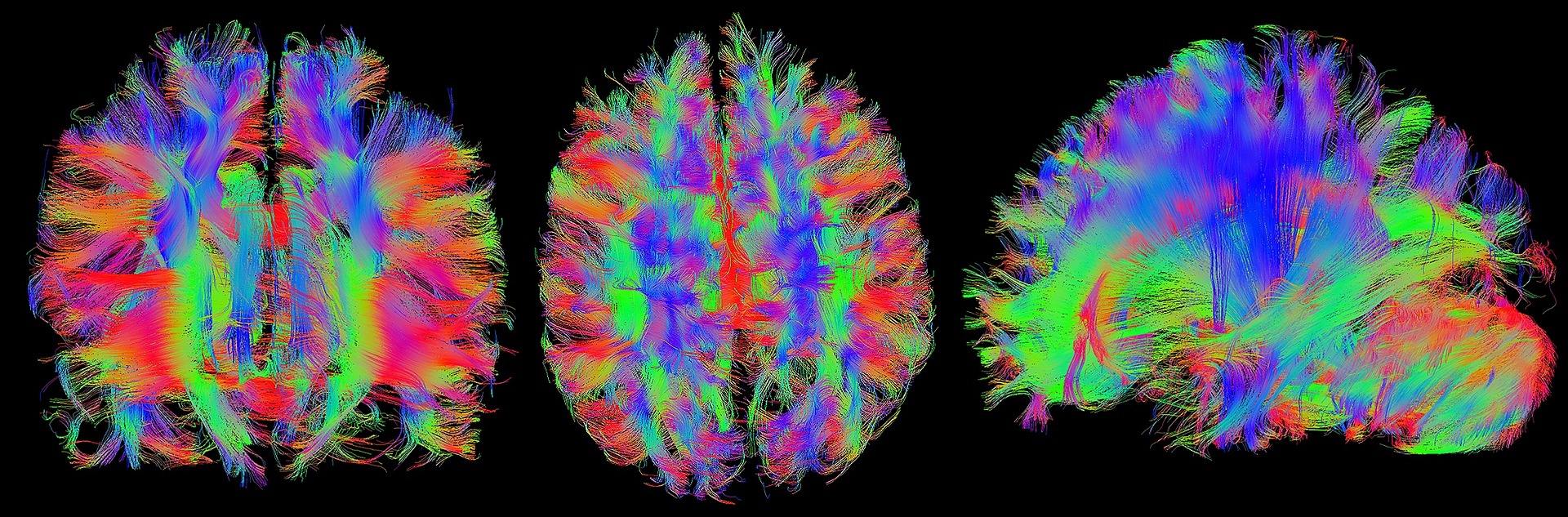 Diffusion Tensor Imaging